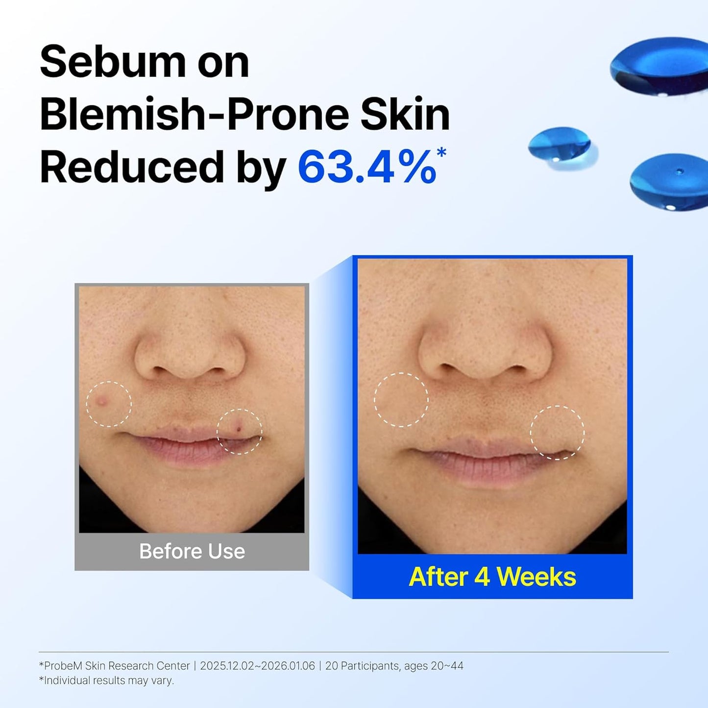 Dear Klairs Korean EGF Serum – Blue Youth Activating Drop with EGF Peptides and Guaiazulene, Repairing Serum for Redness and Blemish-prone Skin, Visibly Fades Post-Blemish Marks, 0.67 Fl Oz